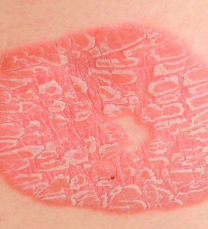 derma-clinic-psoriasis2